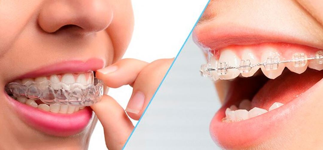 How Does the Invisalign Process in Palos Park, IL Work?