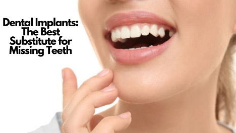 Dental Implants: The Best Substitute for Missing Teeth