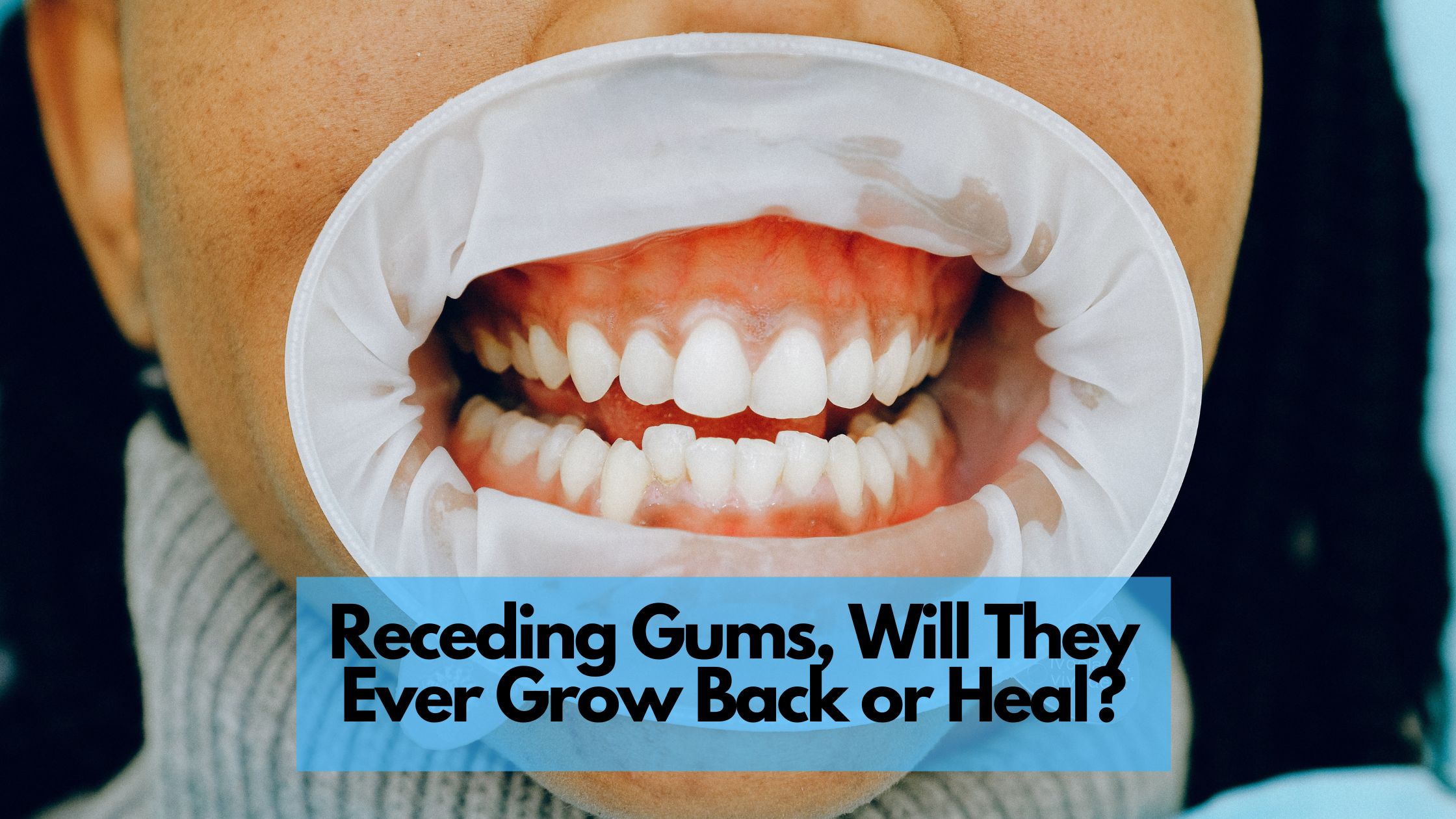 Receding Gums, Will They Ever Grow Back or Heal