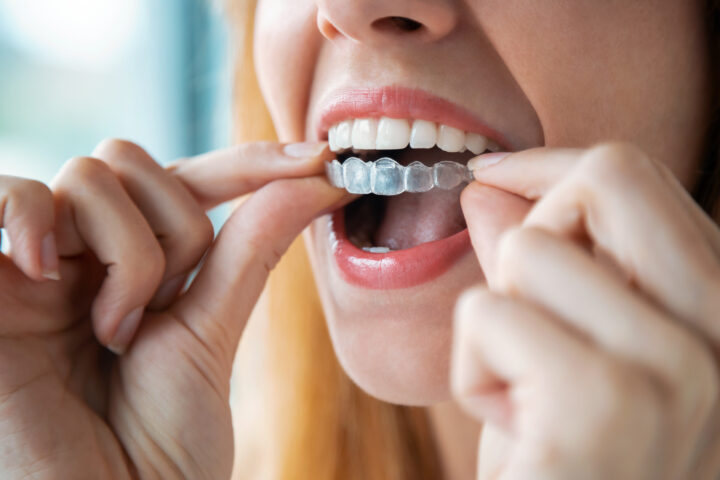What is Invisalign and How Does it Work? 