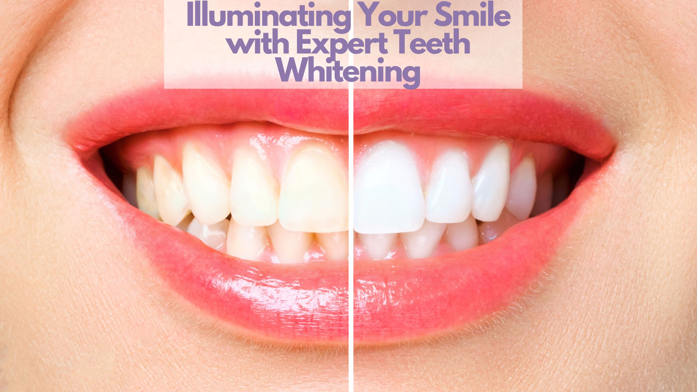 Illuminating Your Smile with Expert Teeth Whitening