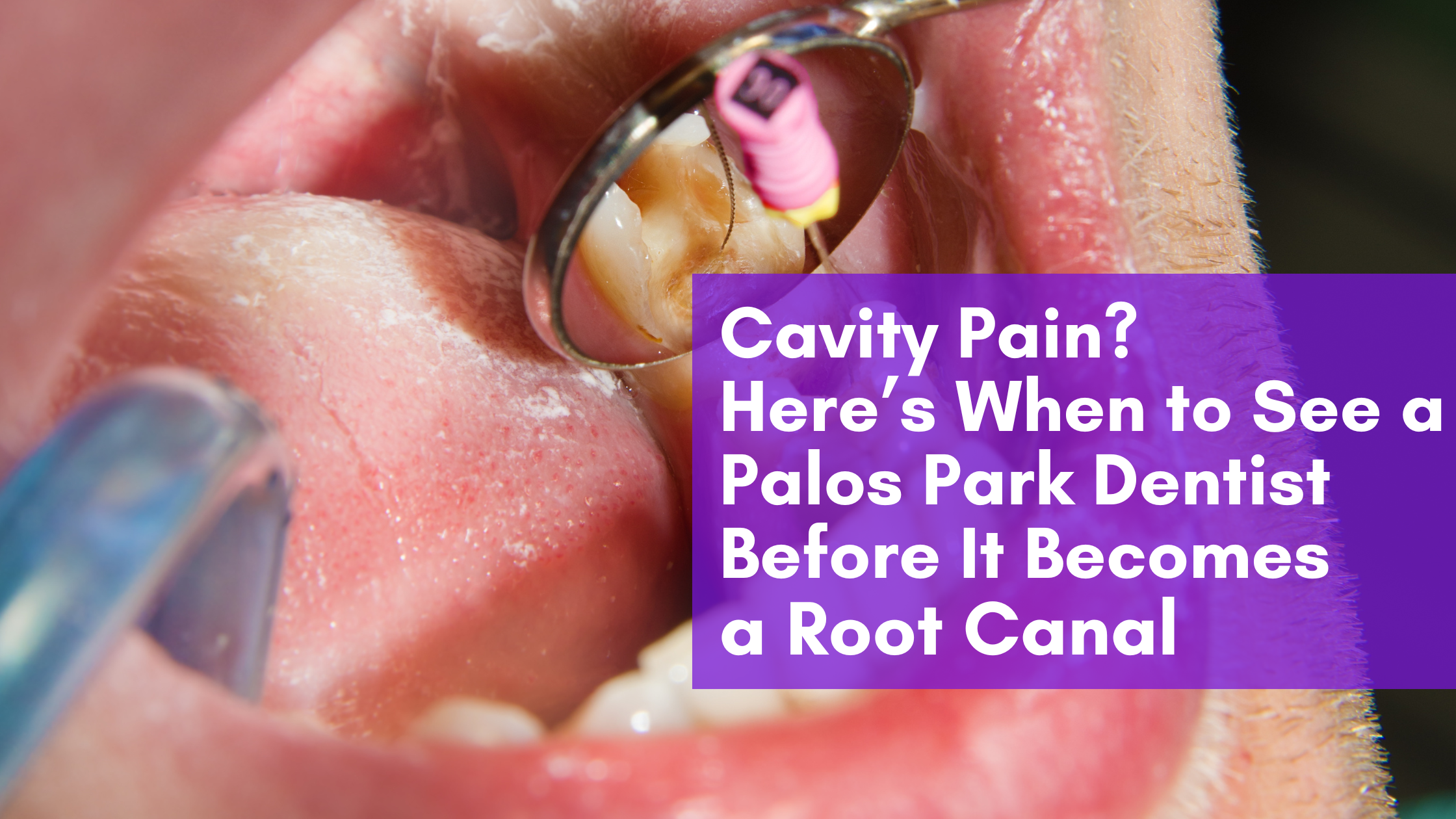 Cavity Pain? When to Visit a Palos Park Dentist Before It Becomes a Root Canal
